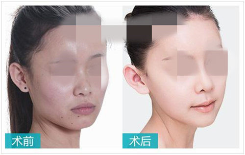 沈阳双美隆鼻哪里好价格是多少