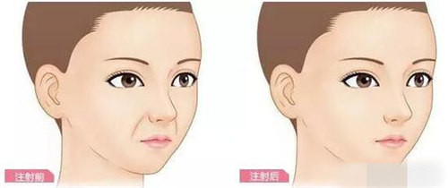 厦门韩式除皱手术费用多少钱呢？