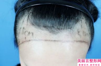 彩光嫩肤改善毛孔粗大要花多少钱