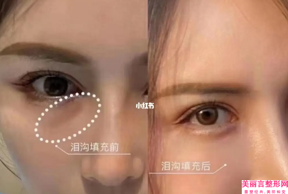 牙齿瓷贴面哪里好？牙齿瓷贴面哪里能做？