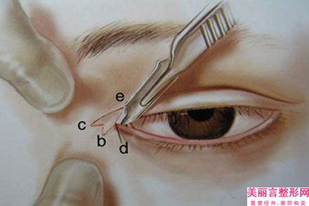 做完眼袋手术会反弹吗？做完眼袋手术眼睑外翻修复要多少钱？