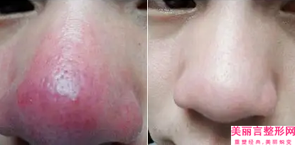 去除双下巴有什么后遗症(去除双下巴有什么后遗症吗)
