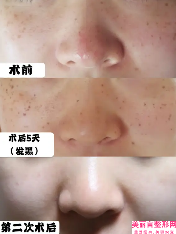 冯士彬整形医生-佛山美莱医疗美容医院冯士彬医生面部红血丝改善私立医美口碑之选
