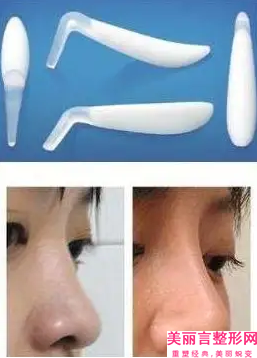 鼻部修复安全吗有没有副作用,鼻部修复安全又可靠的好方法