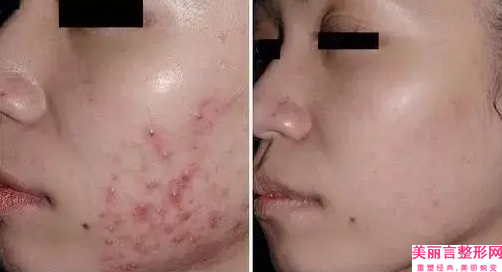 海南省取颊脂垫瘦脸医院口碑榜前十良心表更新-三亚佰思妍医疗美容门诊部连锁谁的技术好人气又高