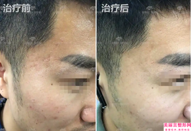 湘西土家族苗族自治州微针面部提升医生排名前十名口碑曝光-谷跃奇医生收费标准、效果图一并分享