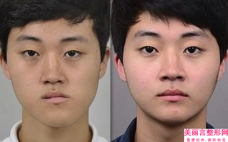 佛山澳玛医疗美容医院彩光嫩肤黑脸娃娃会影响自己的面部表情吗