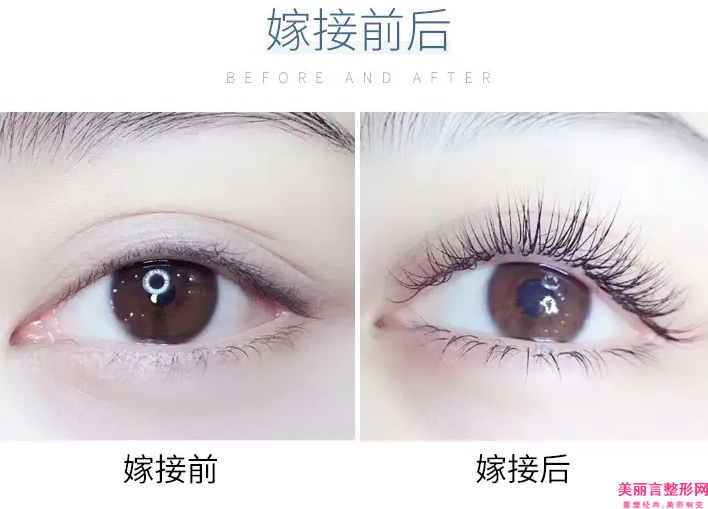 全国眼肌病眼睑下垂医院哪家强：眼肌病眼睑下垂医院前50名独个公布