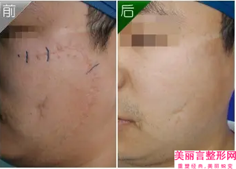 绵阳妙典整形医院做注射瘦脸针手术会不会影响怀孕