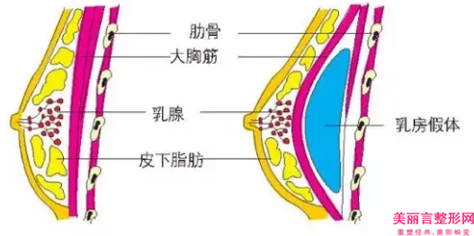 咸阳自体脂肪丰胸做修复会出现后遗症吗