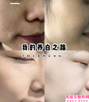 来宾埋线面部提升是否有副作用
