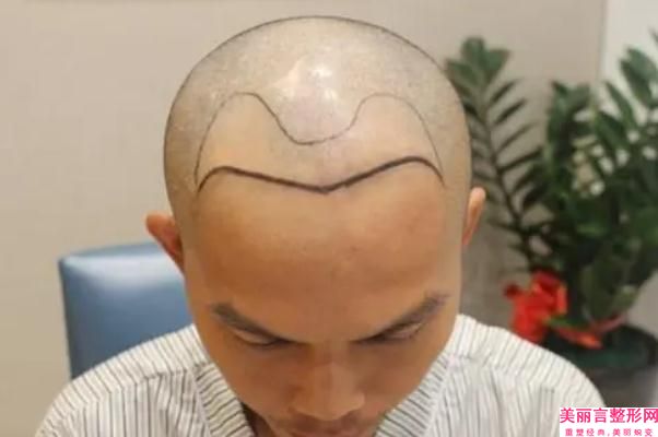 宜昌市额头植发术医生排行榜名单全新汇总-宜昌市杨群申整形医生实力UP