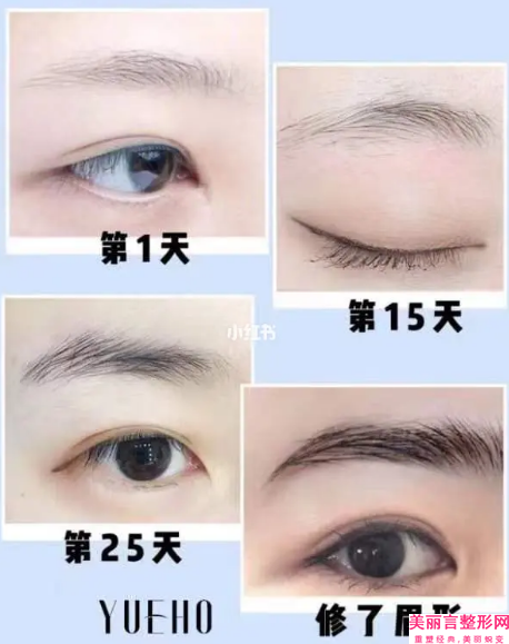衡水市韩式无痕眼袋整容医院-莱斯购微整形公立对比值得一看