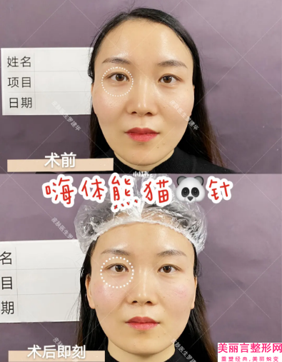 国内线雕去除颈部纹医院哪家好：线雕去除颈部纹医院前50强汇总