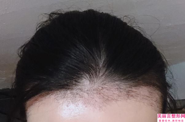 乌鲁木齐女性毛发种植术后效果显著吗