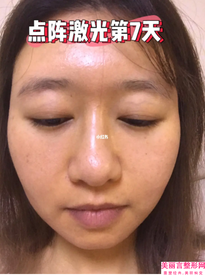 玉溪易多奇医疗美容诊所价格(费用)清单2024版线上咨询附腰腹激光溶脂案例