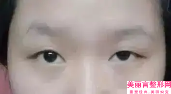 宝鸡市哪医院做做下眼睑切皮手术-爱容妍医疗美容门诊部口碑技术在线