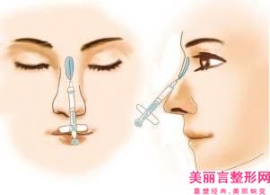 汕头市超肋隆鼻局麻医生排行榜前十强技术实力强-汕头市超肋隆鼻局麻整形医生