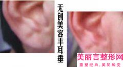 苏州市耳朵贴脑袋矫正价格(费用)清单优惠及医生坐诊名单(近6个月均价为：56754元)