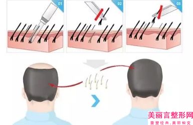 黄冈眉毛种植术手术是否存在风险