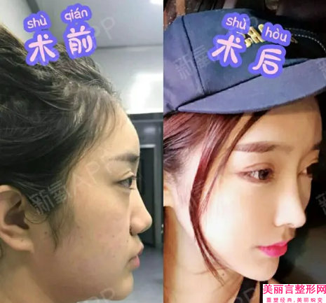 邢台市低鼻梁整形哪个整形医院好(邢台王桂华医疗美容诊所实力派机构稳中求胜)