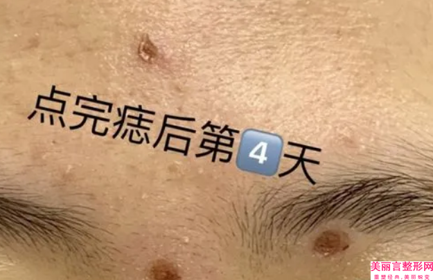 宝鸡渲梦卓美医学美容诊所收费标准在线附o型腿小腿弯曲矫正手术案例