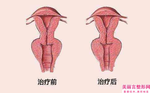 朱晋绮医生-太原市朱晋绮医生做阴蒂肥大术升十强榜