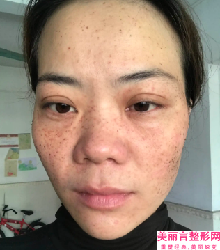 朝阳市面部毛发种植医生排行榜有名气的有哪几位-徐向林医生私立价格超亲民