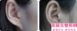 杨晓光整形医生-松原市杨晓光医生耳朵里黑头去除专家更靠谱
