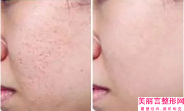 青岛市去除脸上雀斑收费明细简介一览(去除脸上雀斑均价为：1335元)
