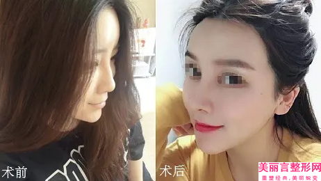 南京市鼻综合整形美容价目表热门项目推荐+-近8个月均价为23797元
