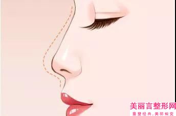 张家港市埋线隆鼻手术费用表明细在此(埋线隆鼻手术均价为：32634元)
