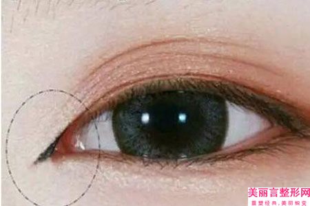 保定蓝山医疗美容医院价位表总览附单眼皮深眼窝看案例