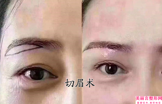 全国眼部外切去眼袋医院排名：眼部外切去眼袋医院前50强哪几家效果好