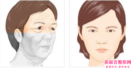 雅安牙齿3DS超薄瓷贴面术能保持多久如何