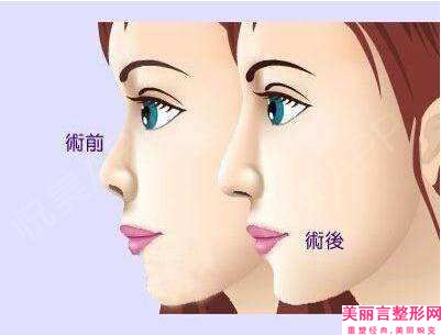 崇左misko埋线隆鼻手术有什么副作用吗