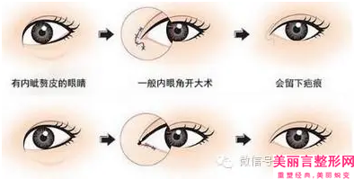 郑州眼部综合提肌术的风险及术后护理注意事项