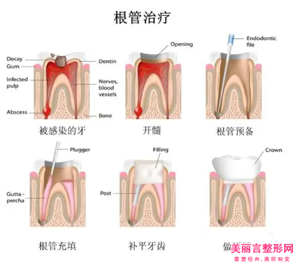 黔西南牙根手术失败修复的适应人群和流程