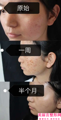 梅州膨体填充面部手术会不会影响视力呢