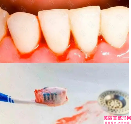 红河牙槽骨吸收术后如何护理才能保证效果呢