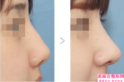 许昌假体窿鼻整形的效果一般为多久