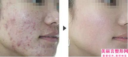 商丘海燕医疗整形医院半飞秒激光近视手术优修复后怎么护理