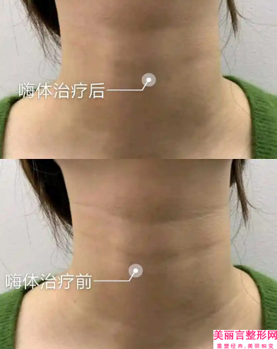 厦门海峡整形美容医院手术除皱后的日常护理有什么