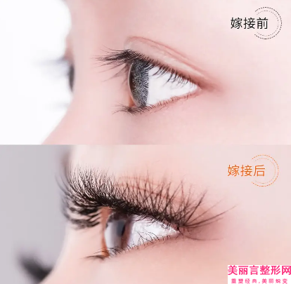 定点双眼皮整形的风险你了解吗