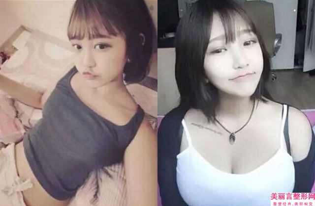 宜春美莱医疗整形美容医院做手臂抽脂手术宜春美莱医疗整形美容医院做案例，术前排雷-附整形收费明细