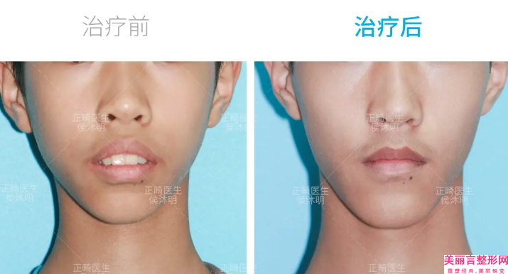 苏州市立医院整形外科门诊部价格表(费用)人气-轻度唇腭裂修复案例
