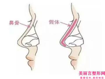 段世荣医生线雕隆鼻和硅胶隆鼻便宜又好-濮阳人民医院烧伤整形科