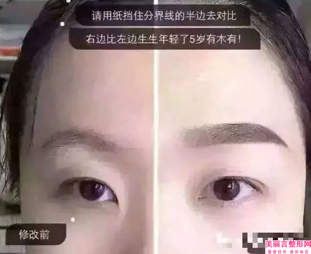 长沙市韩式双眼皮法专业医院哪些比较好-韩式双眼皮法手术治疗多少钱