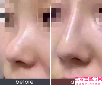 淄博市自体隆鼻膨体隆鼻价格(价目)火爆曝光-淄博市第一医院（总院）价格有多高呢