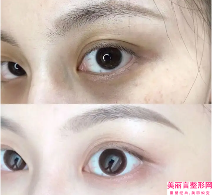 商丘玻尿酸除下眼睑皱纹效果能保持多久时间